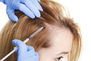 Things You Must Know While Considering Hair Transplant