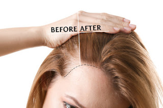 Things You Must Know While Considering Hair Transplant