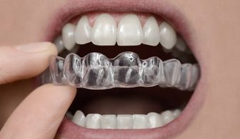 How To Take Care Of Retainers After Braces