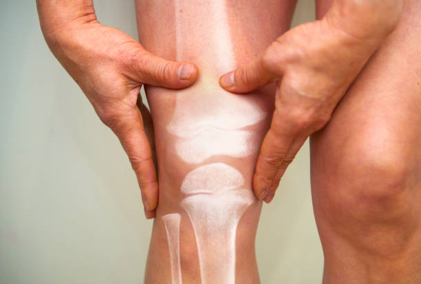 Best Vitamins for Cracking Knees