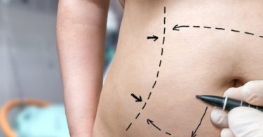 Things to consider before getting a tummy tuck