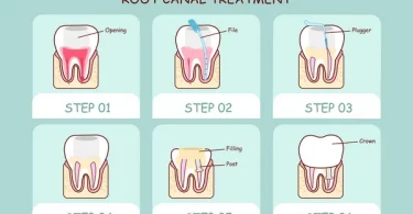 Root Canal Treatment